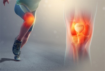 Arthritis (Osteo) 