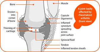 Rheumatoid Arthritis 